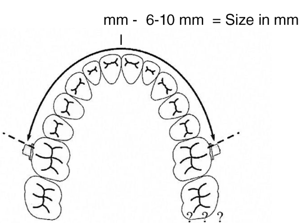 Moláris disztalizáló ív, készlet (1-7 méret) (80 - 98 mm)